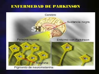 ENFERMEDAD DE PARKINSON
 