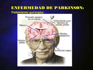 ENFERMEDAD DE PARKINSON:
Tratamiento quirúrgico
 