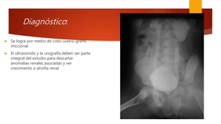 Diagnóstico:
 Se logra por medio de cisto-uretro-grafía
miccional.
 El ultrasonido y la urografía deben ser parte
integral del estudio para descartar
anomalías renales asociadas y ver
crecimiento o atrofia renal.
 