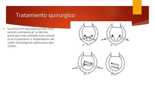 Tratamiento quirurgico
 La corrección quirúrgica puede trans
vesical o extravesical. La técnica
quirúrgica más utilizada trans vesical
es el cruzamiento e implantación del
uréter transtrigonal submucoso tipo
Cohen .
 