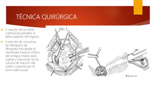 TÉCNICA QUIRÚRGICA
 C reación de un túnel
submucoso paralelo al
labio superior del trígono
 I nserción de una pinza
de Monijan o de
Bengolea fina desde el
neomeato hasta el orificio
del antiguo meato para
sujetar y traccionar de las
suturas de tracción del
uréter y pasarlo por el
túnel submucoso
 
