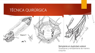 TÉCNICA QUIRÚRGICA
Reimplante en duplicidad ureteral:
Tunelizarse y reimplantarse de manera
conjunta
 