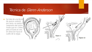Técnica de Glenn-Anderson
 Se trata de una técnica
de avance ureteral,
por tanto, se realiza la
ureterolisis del mismo
modo que en Cohen,
pero el túnel se crea
en dirección hacia el
cuello de la vejiga .
 