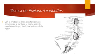 Técnica de Politano-Leadbetter:
 Con la ayuda de la pinza disectora se hace
protusión de la punta de la misma sobre la
pared vesical improntando hacia dentro de la
vejiga
 