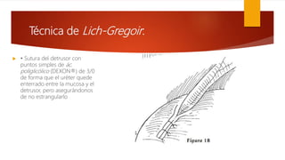 Técnica de Lich-Gregoir:
 • Sutura del detrusor con
puntos simples de ác.
poliglicólico (DEXON®) de 3/0
de forma que el uréter quede
enterrado entre la mucosa y el
detrusor, pero asegurándonos
de no estrangularlo
 