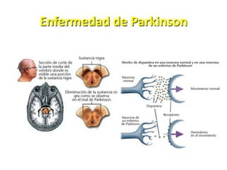 Enfermedad de Parkinson
 