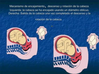 Mecanismo de encajamientoMecanismo de encajamiento,, descenso y rotación de la cabeza.descenso y rotación de la cabeza.
Izquierda: la cabeza se ha encajado usando un diámetro oblicuo.Izquierda: la cabeza se ha encajado usando un diámetro oblicuo.
Derecha: Salida de la cabeza una vez completado el descenso y laDerecha: Salida de la cabeza una vez completado el descenso y la
rotación de la cabeza.rotación de la cabeza.
 