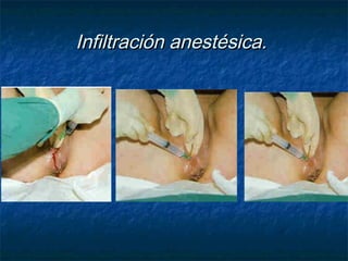 Infiltración anestésica.Infiltración anestésica.
 