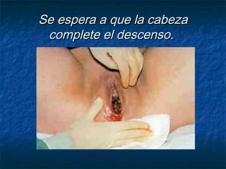 Se espera a que la cabezaSe espera a que la cabeza
complete el descenso.complete el descenso.
 