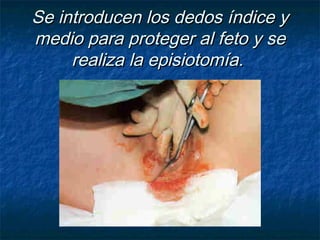 Se introducen los dedos índice ySe introducen los dedos índice y
medio para proteger al feto y semedio para proteger al feto y se
realiza la episiotomía.realiza la episiotomía.
 