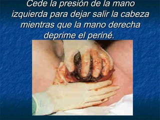 Cede la presión de la manoCede la presión de la mano
izquierda para dejar salir la cabezaizquierda para dejar salir la cabeza
mientras que la mano derechamientras que la mano derecha
deprime el periné.deprime el periné.
 