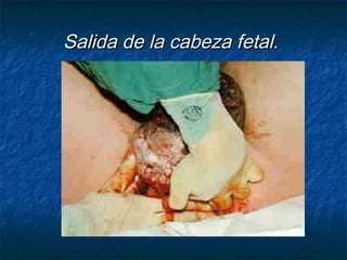 Salida de la cabeza fetal.Salida de la cabeza fetal.
 