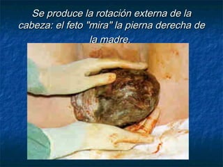 Se produce la rotación externa de laSe produce la rotación externa de la
cabeza: el feto "mira" la pierna derecha decabeza: el feto "mira" la pierna derecha de
la madre.la madre.
 