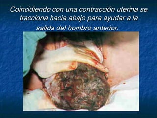 Coincidiendo con una contracción uterina seCoincidiendo con una contracción uterina se
tracciona hacia abajo para ayudar a latracciona hacia abajo para ayudar a la
salida del hombro anterior.salida del hombro anterior.
 