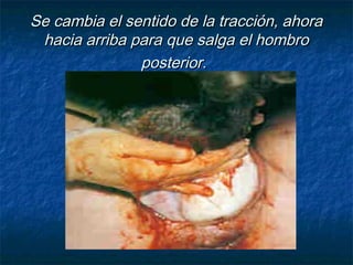 Se cambia el sentido de la tracción, ahoraSe cambia el sentido de la tracción, ahora
hacia arriba para que salga el hombrohacia arriba para que salga el hombro
posterior.posterior.
 