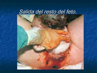 Salida del resto del feto.Salida del resto del feto.
 