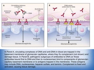 In Panel A, circulating complexes of DNA and anti-DNA in blood are trapped in the
basement membrane of glomerular capillaries, where they fix complement (not shown) and
damage tissue. In Panel B, pathogenic subgroups of antibodies to DNA (or those
antibodies bound first to DNA and then to nucleosomes) bind to components of glomerularcapillary basement membrane or to antigens trapped in the membrane. These antigens
may include DNA, nucleosomes, heparan sulfate, and laminin. Complement is fixed and
activated, causing tissue damage.

 