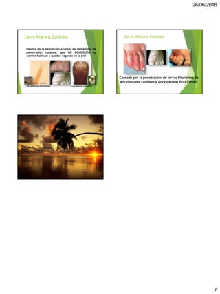 26/06/2018
7
Larva Migrans Cutánea
Ancylostoma braziliense Ancylostoma caninum
1 par de dientes 3 pares de dientes
Resulta de la exposición a larvas de nemátodes de
penetración cutánea, que NO CONSIGUEN su
camino habitual y quedan vagando en la piel
Larva Migrans Cutánea
Causada por la penetración de larvas filarioides de
Ancylostoma caninum y Ancylostoma braziliensis
 