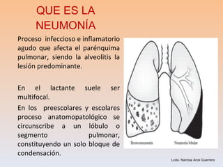 QUE ES LA NEUMONÍA Proceso  infeccioso e inflamatorio agudo que afecta el parénquima pulmonar, siendo la alveolitis la lesión predominante. En el lactante suele ser multifocal. En los  preescolares y escolares proceso anatomopatológico se circunscribe a un lóbulo o segmento pulmonar, constituyendo un solo bloque de condensación. Lcda. Narcisa Arce Guerrero 