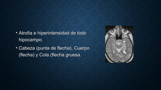 • Atrofia e hiperintensidad de todoAtrofia e hiperintensidad de todo
hipocampo.hipocampo.
• Cabeza (punta de flecha), CuerpoCabeza (punta de flecha), Cuerpo
(flecha) y Cola (flecha gruesa.(flecha) y Cola (flecha gruesa.
 