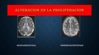 ALTERACION EN LA PROLIFERACIONALTERACION EN LA PROLIFERACION
MICROLISENCEFALIA HEMIMEGALOENCEFALIA
 