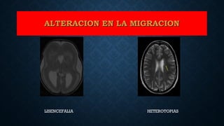 ALTERACION EN LA MIGRACIONALTERACION EN LA MIGRACION
HETEROTOPIASLISENCEFALIA
 