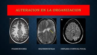 ALTERACION EN LA ORGANIZACIONALTERACION EN LA ORGANIZACION
DISPLASIA CORTICAL FOCALESQUISENCEFALIAPOLIMICROGIRIA
 