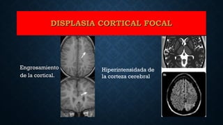 EngrosamientoEngrosamiento
de la cortical.de la cortical.
Hiperintensidada de
la corteza cerebral
DISPLASIA CORTICAL FOCALDISPLASIA CORTICAL FOCAL
 