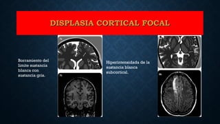 Borramiento del
limite sustancia
blanca con
sustancia gris.
Hiperintensidada de la
sustancia blanca
subcortical.
DISPLASIA CORTICAL FOCALDISPLASIA CORTICAL FOCAL
 