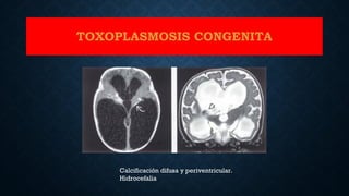 TOXOPLASMOSIS CONGENITA
Calcificación difusa y periventricular.
Hidrocefalia
 