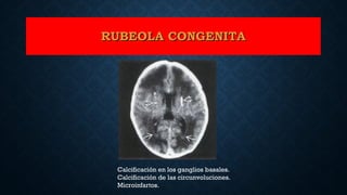 RUBEOLA CONGENITARUBEOLA CONGENITA
Calcificación en los ganglios basales.
Calcificación de las circunvoluciones.
Microinfartos.
 