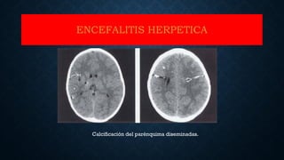 ENCEFALITIS HERPETICA
Calcificación del parénquima diseminadas.
 