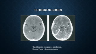 TUBERCULOSISTUBERCULOSIS
Calcificación con realce periferico.
Realce Paqui y leptomeningeo.
 