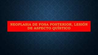 NEOPLASIA DE FOSA POSTERIOR, LESIÓN
DE ASPECTO QUÍSTICO
 