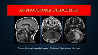 Tumoración quística cerebelosa con nódulo mural. Astrocitoma pilocítico.
T1 T2
ASTROCITOMA PILOCÍTICOASTROCITOMA PILOCÍTICO
 