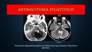 Tumoración infratentorial quística con nódulo que capta contraste. Astrocitoma
pilocítico.
T2
ASTROCITOMA PILOCÍTICOASTROCITOMA PILOCÍTICO
T1+C
 