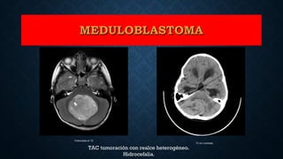 TC sin contraste
Potenciada en T2
MEDULOBLASTOMAMEDULOBLASTOMA
TAC tumoración con realce heterogéneo.
Hidrocefalia.
 