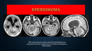 TAC tumoración en cuarto ventrículo polilobulda con
pequeños focos de calcificación con realce heterogéneo.
Hidrocefalia.
EPENDIMOMAEPENDIMOMA
 