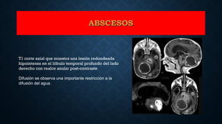 T1 corte axial que muestra una lesión redondeada
hipointensa en el lóbulo temporal profundo del lado
derecho con realce anular post-contraste
Difusión se observa una importante restricción a la
difusión del agua.
ABSCESOSABSCESOS
 