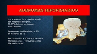 Los adenomas de la hipófisis anterior
son neoplasias benignas,
10-15% de todos los tumores
intracraneales.
Aparecen en la vida adulta y < 3%
en menores de 18
Por convención < 10mm son llamados
Microadenomas y mayores son los
Macroadenomas.
ADENOMAS HIPOFISIARIOSADENOMAS HIPOFISIARIOS
 