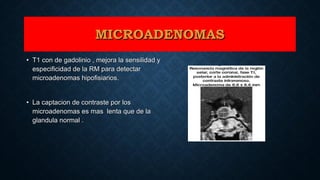 • T1 con de gadolinio , mejora la sensilidad yT1 con de gadolinio , mejora la sensilidad y
especificidad de la RM para detectarespecificidad de la RM para detectar
microadenomas hipofisiarios.microadenomas hipofisiarios.
• La captacion de contraste por losLa captacion de contraste por los
microadenomas es mas lenta que de lamicroadenomas es mas lenta que de la
glandula normal .glandula normal .
MICROADENOMASMICROADENOMAS
 