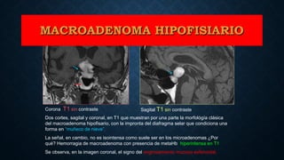 Dos cortes, sagital y coronal, en T1 que muestran por una parte la morfológía clásica
del macroadenoma hipofisario, con la impronta del diafragma selar que condiciona una
forma en “muñeco de nieve”.
La señal, en cambio, no es isointensa como suele ser en los microadenomas ¿Por
qué? Hemorragia de macroadenoma con presencia de metaHb, hiperintensa en T1
Se observa, en la imagen coronal, el signo del engrosamiento mucoso esfenoidal.
Coronal T1 sin contraste Sagital T1 sin contraste
MACROADENOMA HIPOFISIARIOMACROADENOMA HIPOFISIARIO
 
