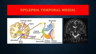 EPILEPSIA TEMPORAL MESIAL
 