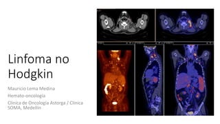 Linfoma no
Hodgkin
Mauricio Lema Medina
Hemato-oncología
Clínica de Oncología Astorga / Clínica
SOMA, Medellín
 
