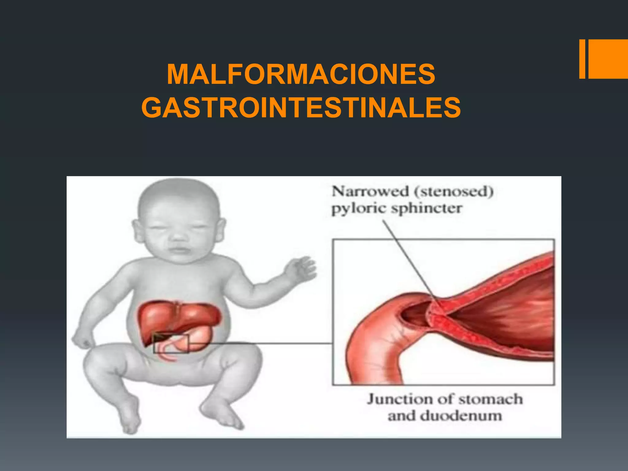 estenosis pilorica | PPTX