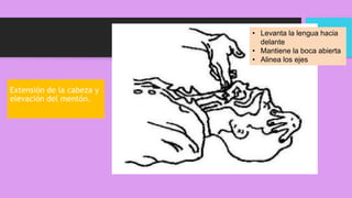 Extensión de la cabeza y
elevación del mentón.
• Levanta la lengua hacia
delante
• Mantiene la boca abierta
• Alinea los ejes
 