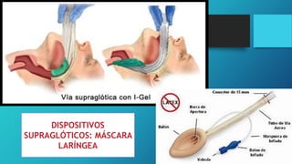 DISPOSITIVOS
SUPRAGLÓTICOS: MÁSCARA
LARÍNGEA
 