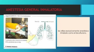 ANESTESIA GENERAL INHALATORIA
Se utiliza exclusivamente anestésico
inhalado como el Sevoflurano.
 