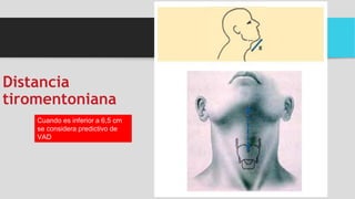 Distancia
tiromentoniana
Cuando es inferior a 6,5 cm
se considera predictivo de
VAD
 