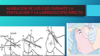 ALINEACIÓN DE LOS EJES DURANTE LA
VENTILACIÓN Y LA LARINGOSCOPÍA DIRECTA
 